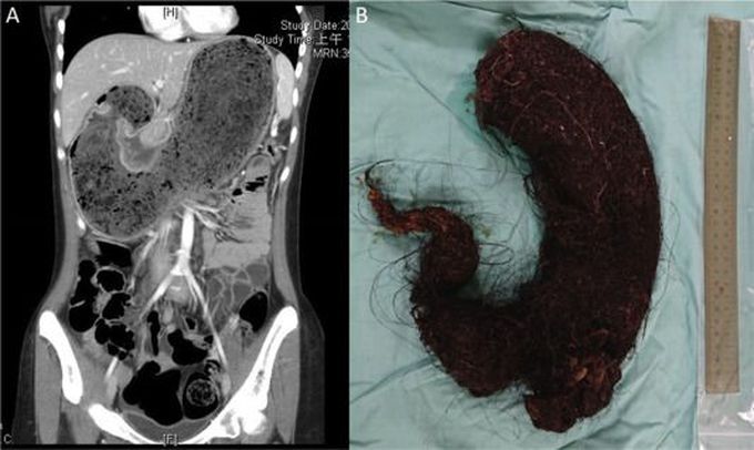 A young girl with a large trichobezoar in her stomach!