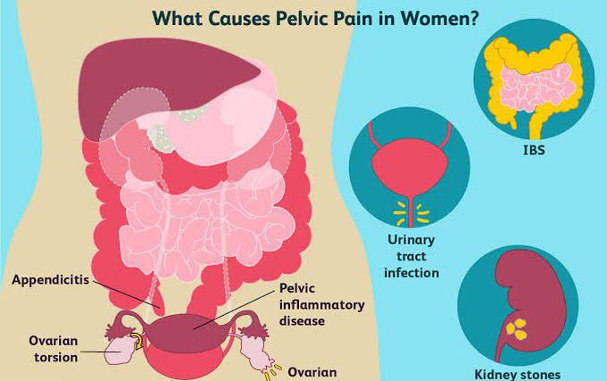 These are the causes of Pelvic Pain in women