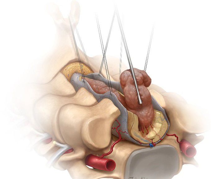 Treatment for Spinal tumor