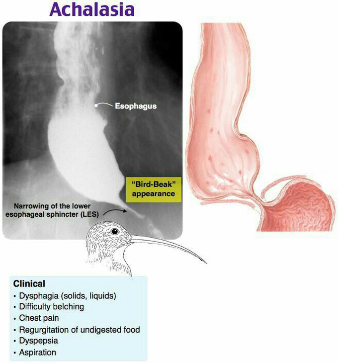 Esophageal achalasia