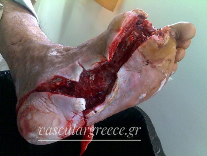 Diabetic foot