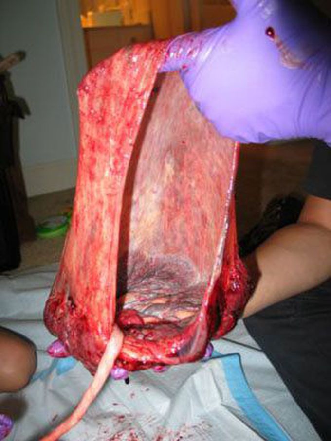 Placenta expulsion