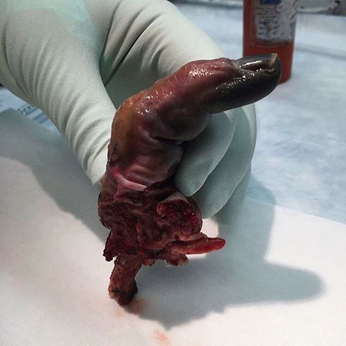 Ischemic finger in a case of a complicated tenosynovitis! 