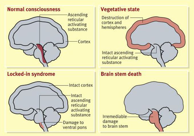 Brain stem death