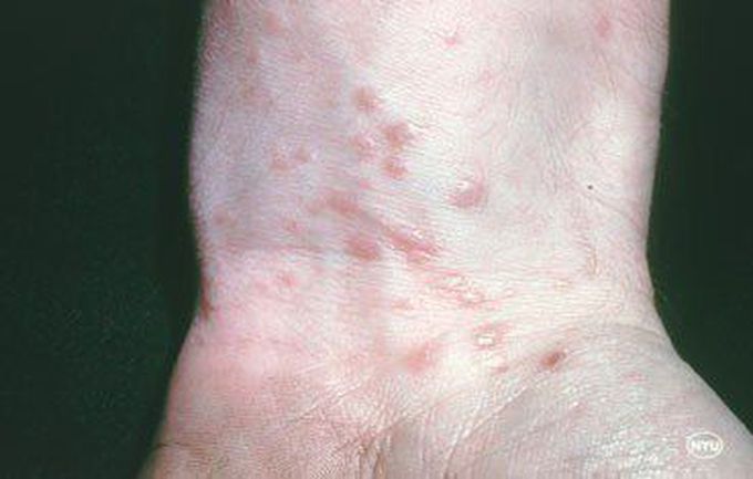 lichen planus