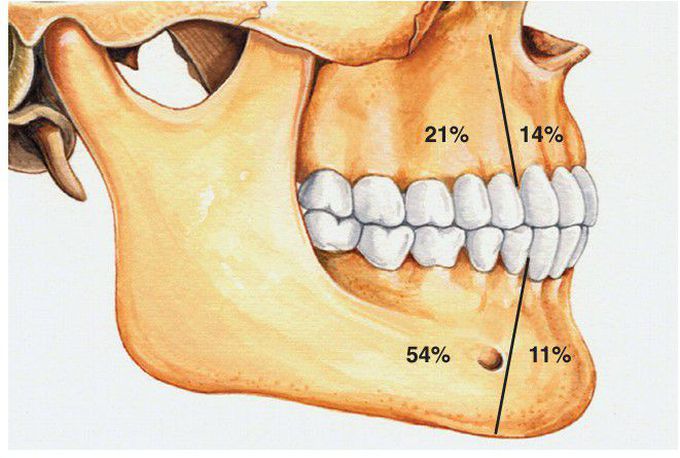 Ameloblastic Fibro-Odontoma distribution