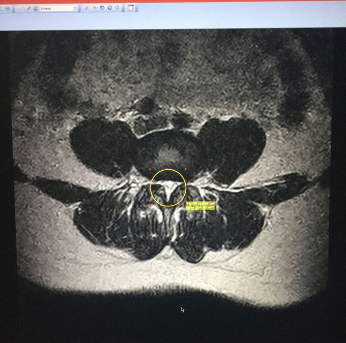 Spinal Stenosis