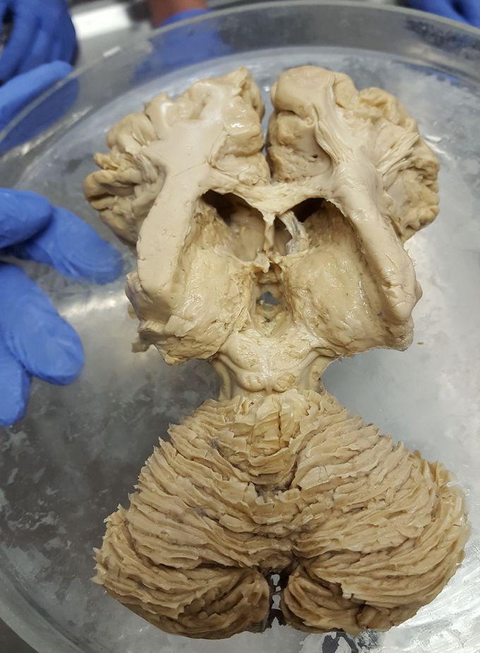 Dissected brain