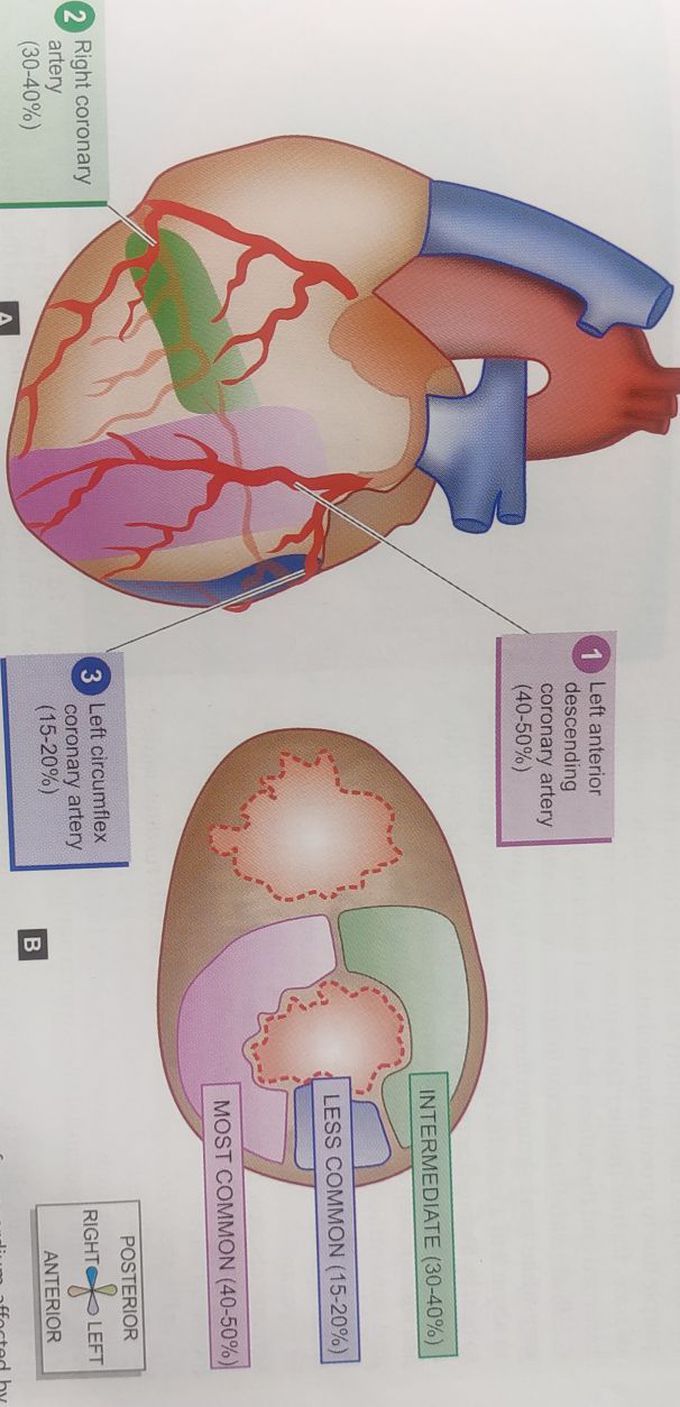 Incidence of myocardial infarction in coronary arteries