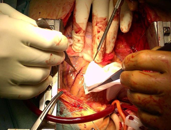 An amazing case of coronary artery bypass grafting