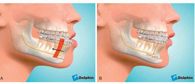 Anterior mandibular subapical osteotomy