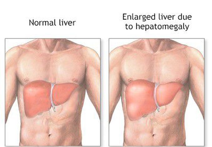 Hepatosplenomegaly