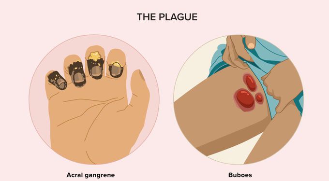 Bubonic plague