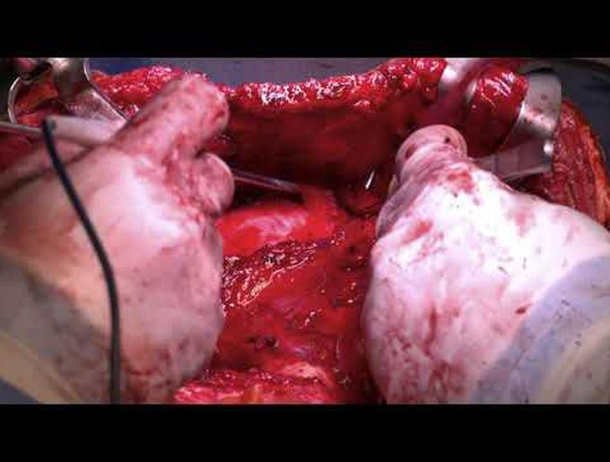 Clamshell Approach for Growing Teratoma Syndrome