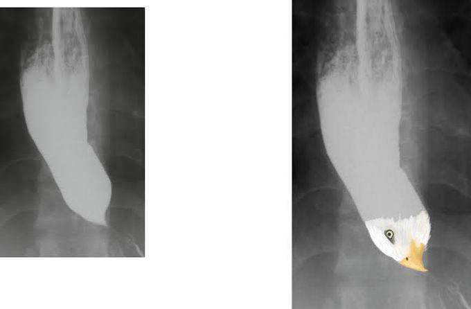 Achalasia (Bird’s beak appearance)