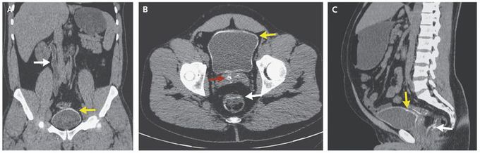 Eggshell Calcifications of the Bladder