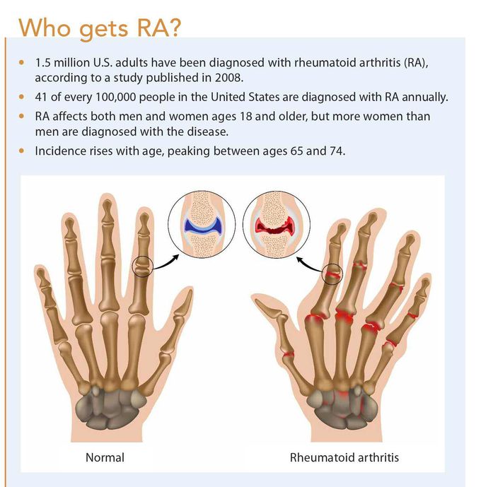 R arthritis