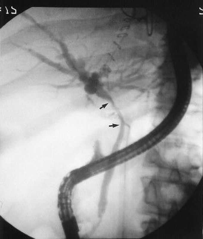 Pseudocholecystitis