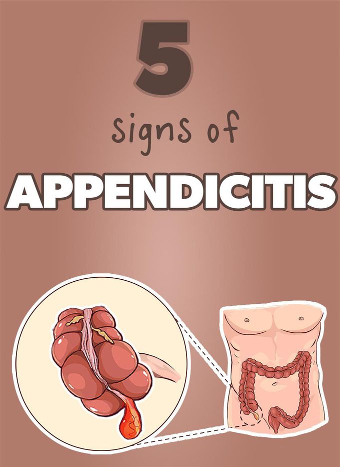5 signs of appendicitis