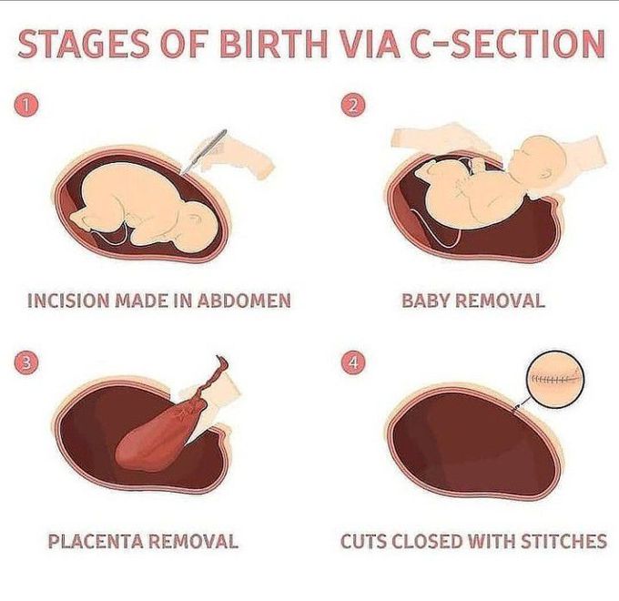 Stages of birth via C-section