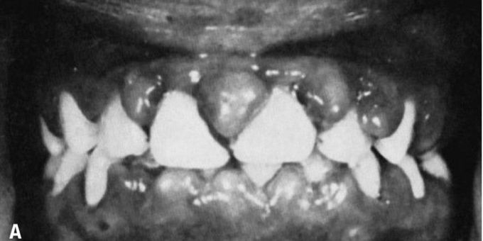 Gingival enlargement