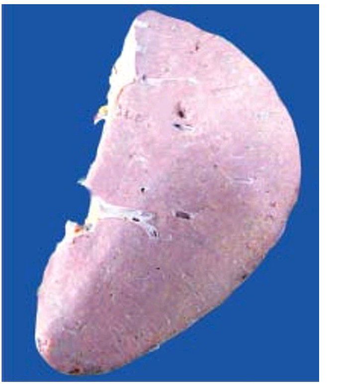 Lardaceous amyloidosis of the spleen.