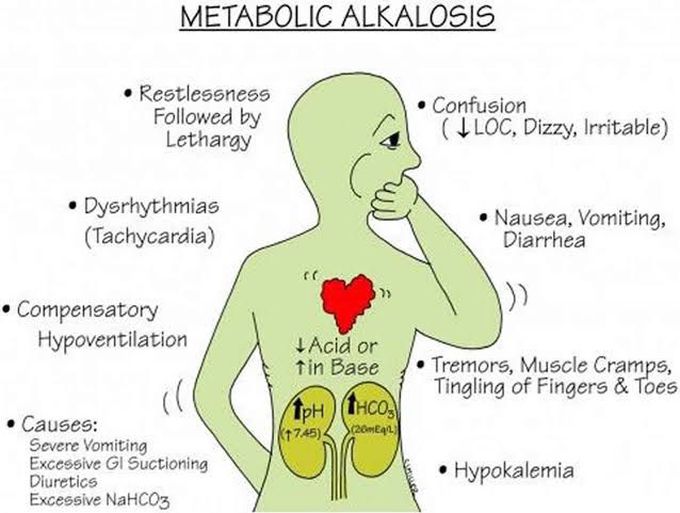 Metabolic Alkalosis