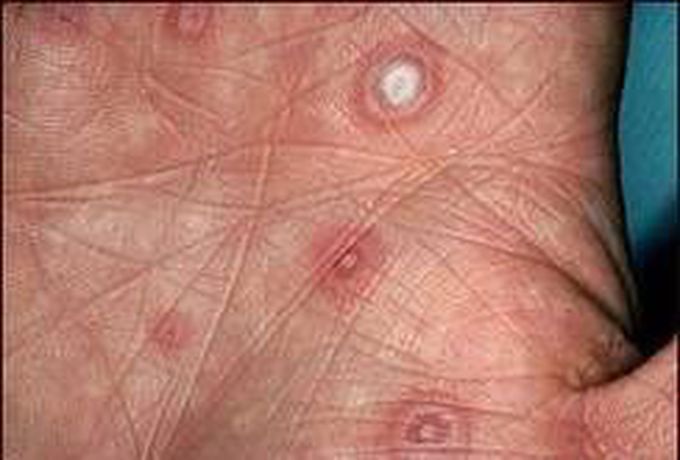 Lesions on Palms and Soles