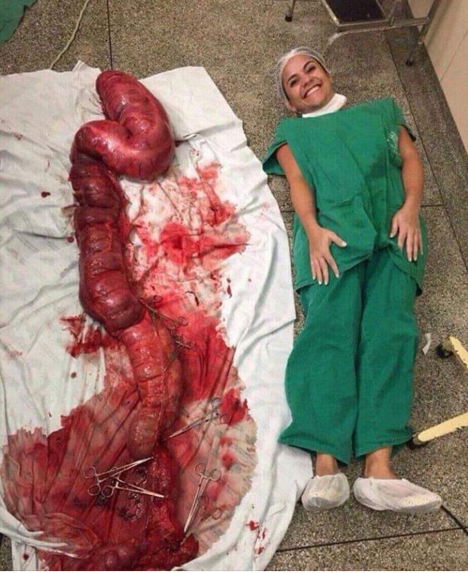 Toxic megacolon for IBD patients