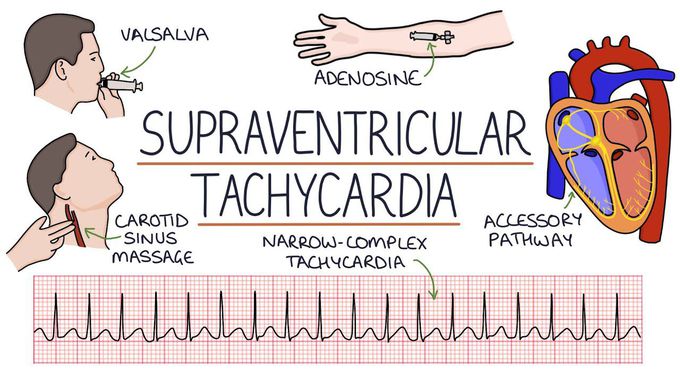 Understanding Supraventricular Tachycardia (SVT)