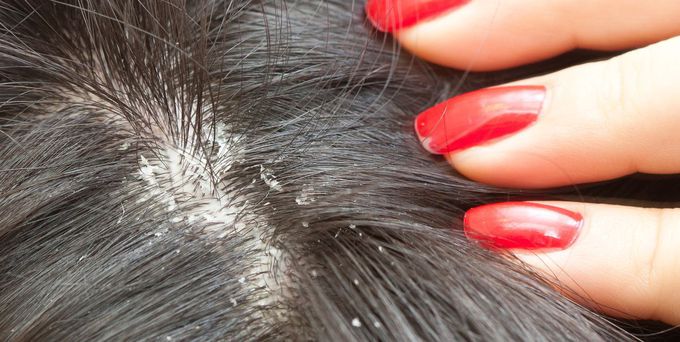 Risk factors of dandruff