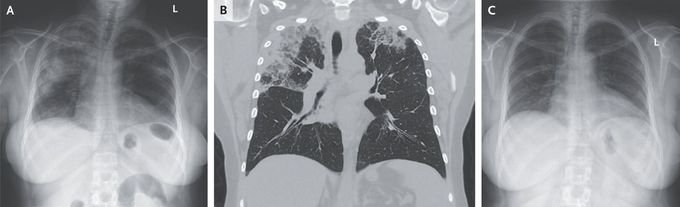 “Photographic Negative of Pulmonary Edema” in Chronic Eosinophilic Pneumonia