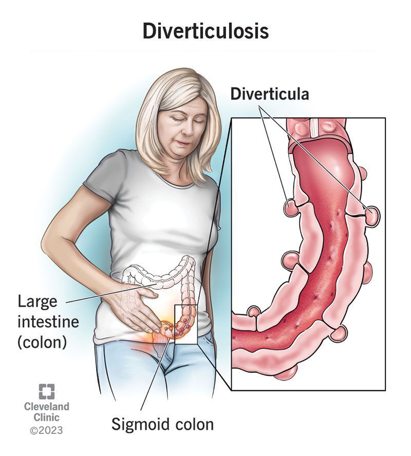 symptoms-of-diverticulosis-medizzy