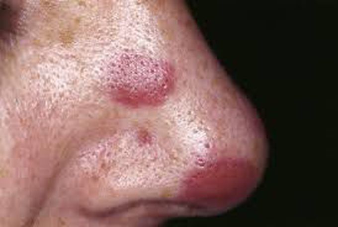 Kaposi sarcoma