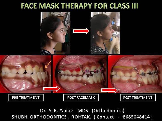 Facemask Therapy for Class III