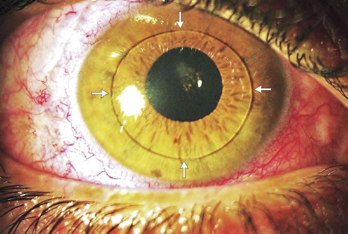 Anterior Dislocation of the Lens