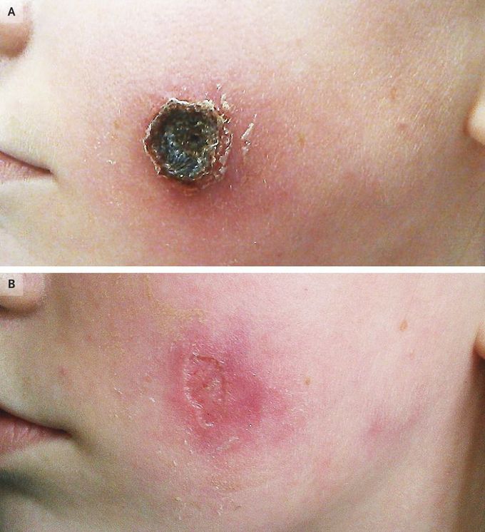 Cowpox Virus Infection