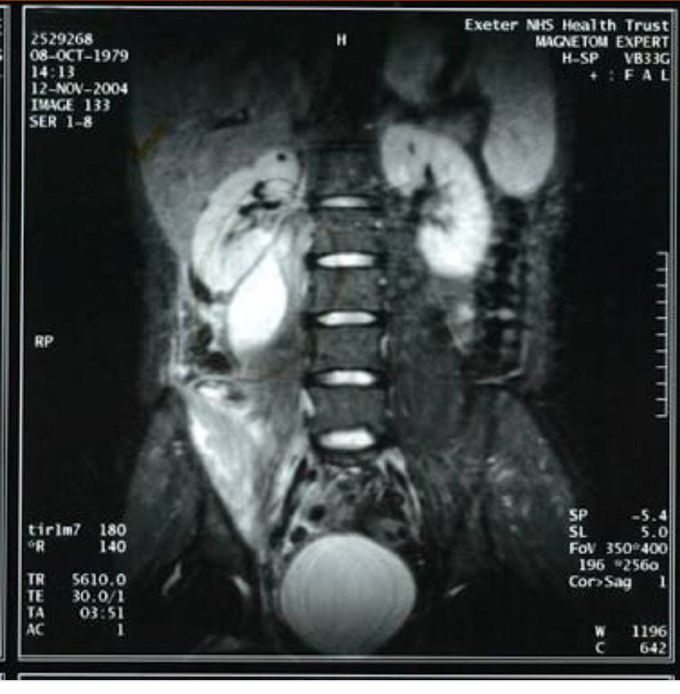 Psoas abscess