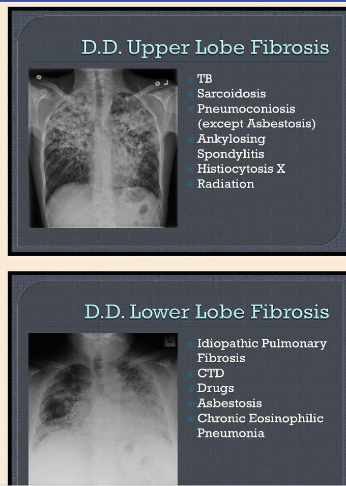 D.D upper&lower lobe fibrosis