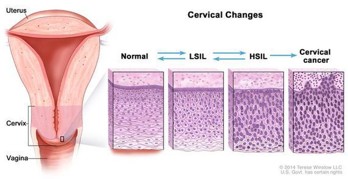 classification-of-cervical-intraepithelial-neoplasia-medizzy