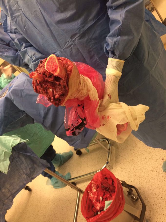 Amputated right leg