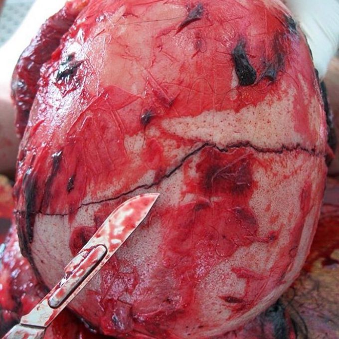 Fissure fracture of the vault of the skull