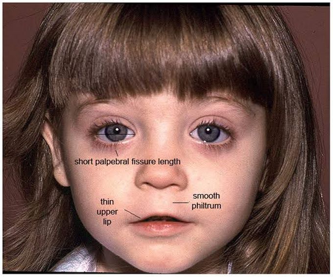 fetal-alcohol-syndrome-medizzy