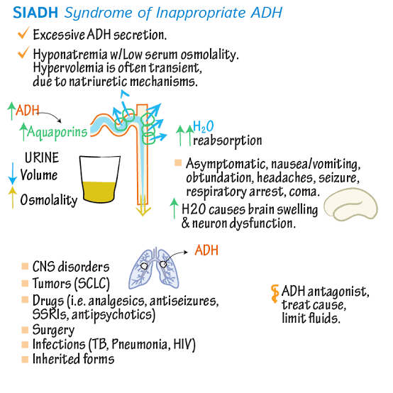 SIADH, Causes, Symptoms, Diagnosis, Treatment Prognosis, 55% OFF