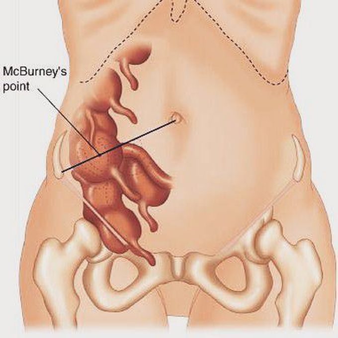 Аппендицит расположен. Точка Мак Бурнея. Точка Ланца и Мак Бурнея. Точка Мак Бурнея расположение. Тазовое расположение аппендицита.